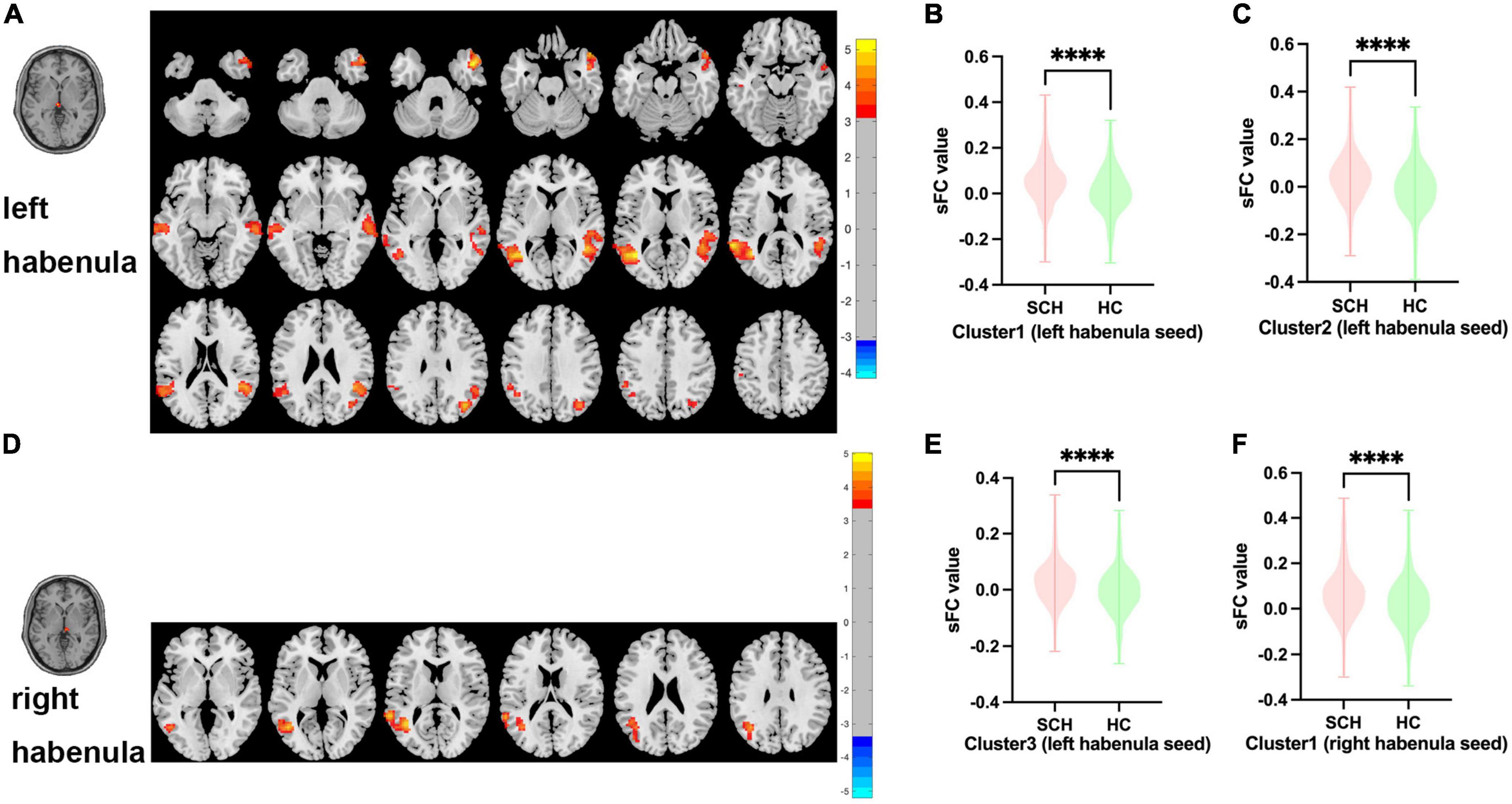 Altered static and dynamic functional connectivity of habenula in first-episode, drug-naïve schizophrenia patients, and their association with symptoms including hallucination and anxiety